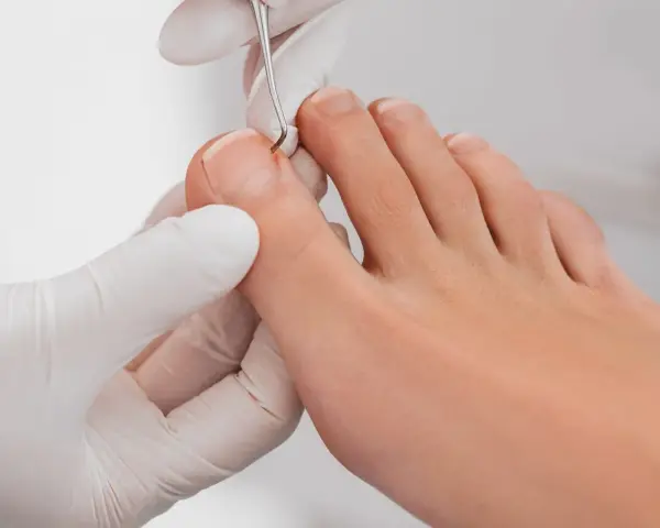 Jak zrobić tamponadę paznokcia? Ulga od wrastania krok po kroku