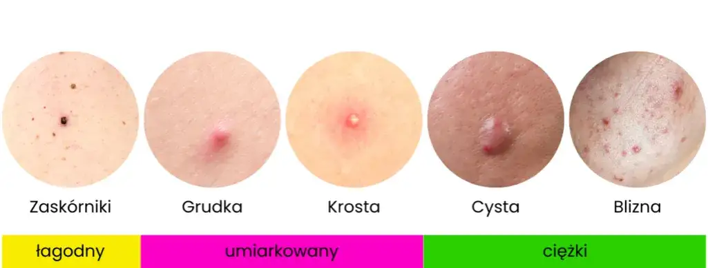 Rodzaje niedoskonałości skóry: trądzik, zaskórniki, przebarwienia
